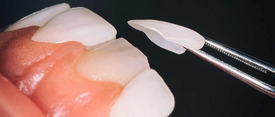مزایای لمینیت دندان